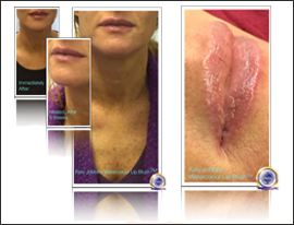 43-Katy Jobbins Permanent Makeup Healed Watercolour Lip Blush FI 43-Katy Jobbins Permanent Makeup Healed Watercolour Lip Blush FI